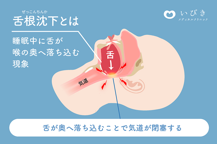 いびきの主な原因は舌根沈下