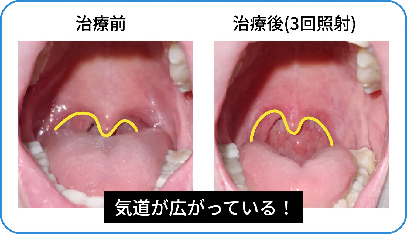 治療前と治療後(3回照射)気道が広がっている