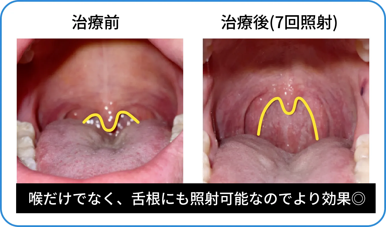 治療前と治療後(7回照射)喉だけでなく舌根にも照射可能なのでより効果的