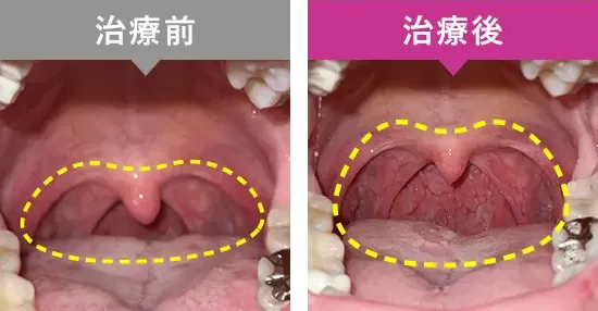 6回コース男性のパルスサーミアによるいびき治療の症例