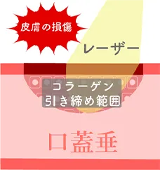 ナイトレーズ等の切らないレーザー治療では皮膚の損傷があり、引き締め効果が低い
