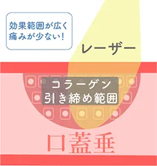 パルスサーミアによるレーザー治療では粘膜表面にやけどがなく、引き締め効果が高い