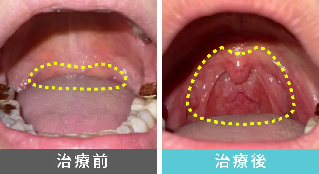 女性、30代のいびき治療、喉奥の症例写真