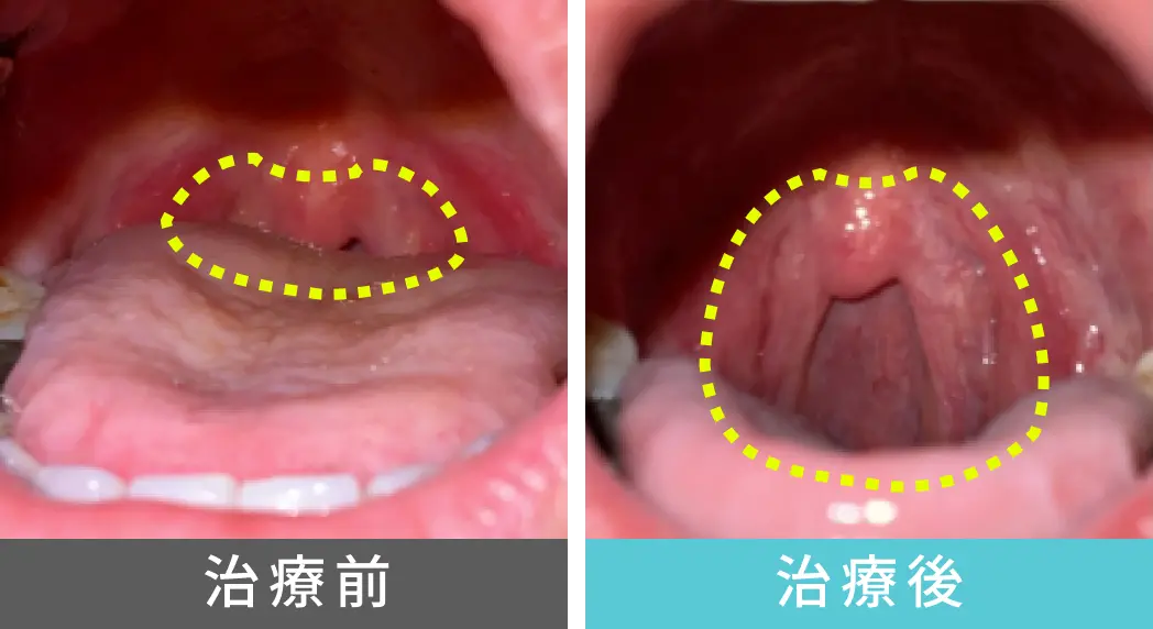 女性、40代のいびき治療、喉奥の症例写真