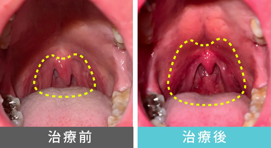 男性、50代の睡眠時無呼吸症候群の治療、喉奥の症例写真