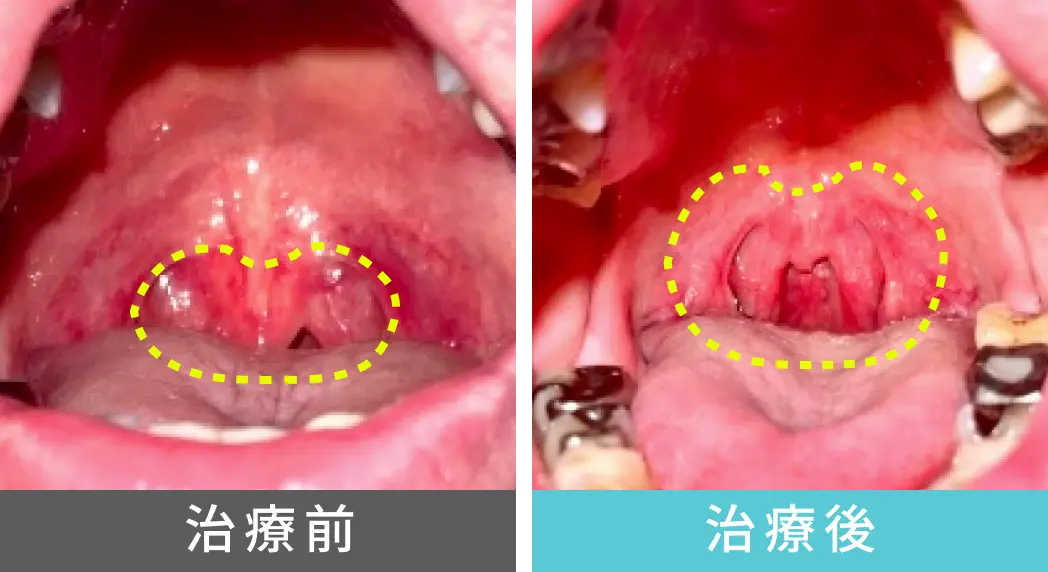 男性、50代の睡眠時無呼吸症候群の治療、喉奥の症例写真