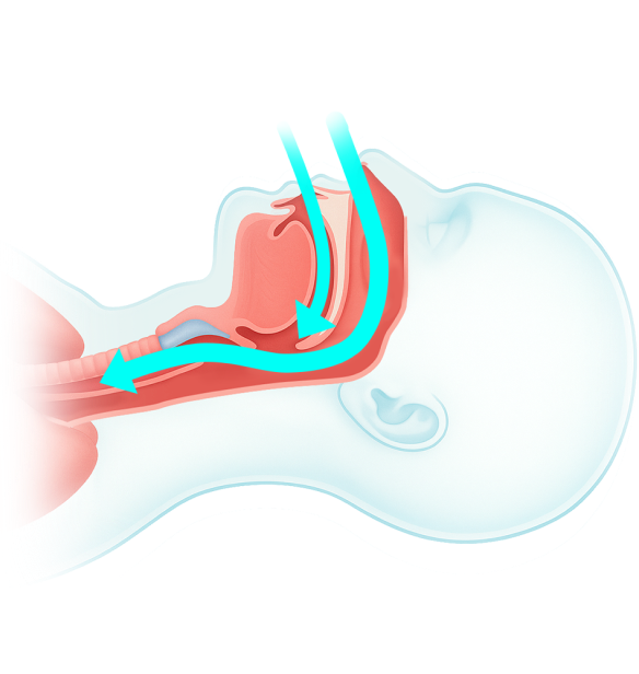 正常な状態の気道の図