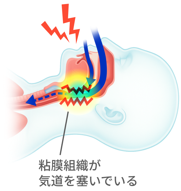 粘膜組織が起動を塞いでいる図