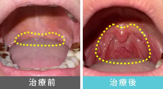 女性、30代のいびき治療、喉奥の症例写真
