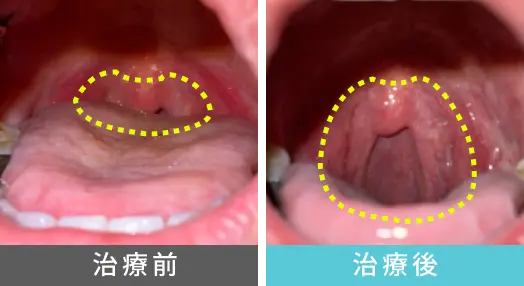 女性、40代のいびき治療、喉奥の症例写真
