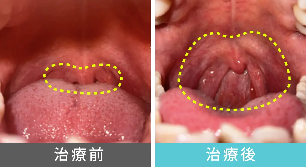 女性、40代の睡眠時無呼吸症候群の治療、喉奥の症例写真