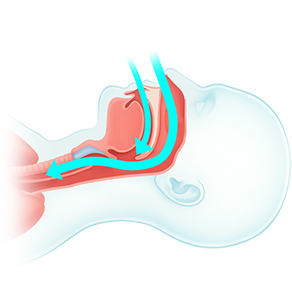 正常な状態の気道の図