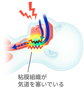 粘膜組織が起動を塞いでいる図