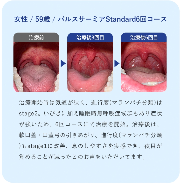 女性 / 59歳 / パルスサーミアStandard6回コース 治療開始時は気道が狭く、進行度(マランパチ分類)はstage2。いびきに加え睡眠時無呼吸症候群もあり症状が強いため、6回コースにて治療を開始。治療後は、軟口蓋・口蓋弓の引きあがり、進行度(マランパチ分類)もstage1に改善、息のしやすさを実感でき、夜目が覚めることが減ったとのお声をいただいてます。