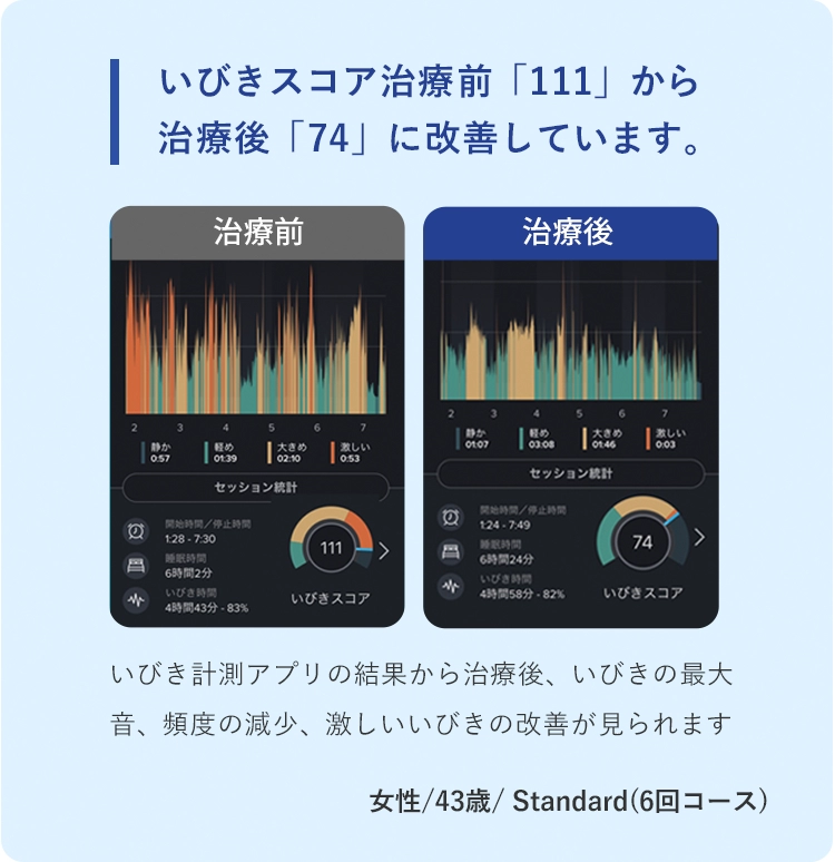 いびきスコア治療前「111」から治療後「74」に改善しています。 治療前 治療後 いびき計測アプリの結果から治療後、いびきの最大音、頻度の減少、激しいいびきの改善が見られます。　43歳 女性 Standard(6回コース)