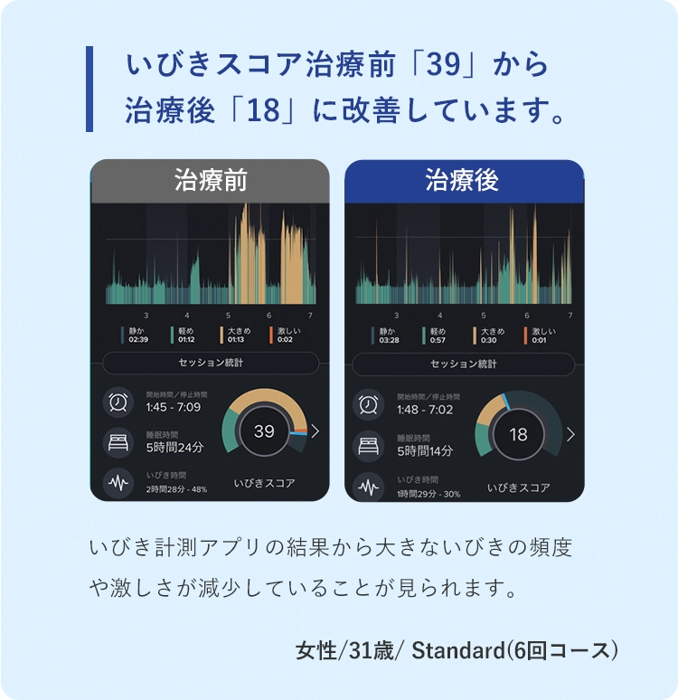 いびきスコア治療前「39」から治療後「18」に改善しています。 治療前 治療後 いびき計測アプリの結果から大きないびきの頻度や激しさが減少していることが見られます。 31歳 女性 Standard(6回コース)