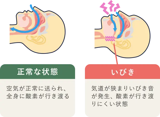 正常な状態：空気が正常に送られ、全身に酸素が行き渡る　いびき：気道が狭まりいびき音が発生、酸素が行き渡りにくい状態