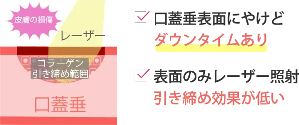 切らないから痛くない出血なし×ダウンタイムほぼなし