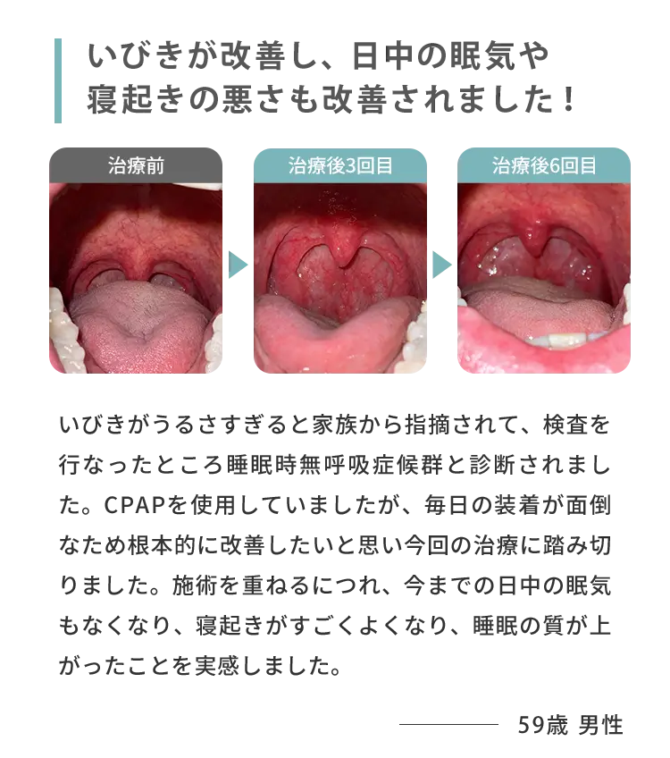 いびきが改善されて日中の眠気や寝起きが改善されました！ 治療前 治療後3回目 治療後6回目 いびきがうるさすぎると家族から指摘されて、検査を行なったところ睡眠時無呼吸症候群と診断されました。CPAPを使用していましたが、毎日の装着が面倒なため根本的に改善したいと思い今回の治療に踏み切りました。施術を重ねるにつれ、今までの日中の眠気もなくなり、寝起きがすごくよくなり、睡眠の質が上がったことを実感しました。 59歳男性
