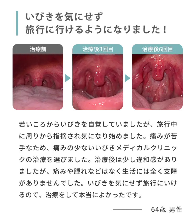 いびきを気にせず旅行に行けるようになりました！ 治療前 治療後3回目 治療後6回目 若いころからいびきを自覚していましたが、旅行中に周りから指摘され気になり始めました。痛みが苦手なため、痛みの少ないいびきメディカルクリニックの治療を選びました。治療後は少し違和感がありましたが、痛みや腫れなどはなく生活には全く支障がありませんでした。いびきを気にせず旅行にいけるので、治療をして本当によかったです。 64歳男性