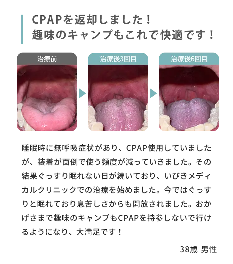 CPAPを返却しました！趣味のキャンプもこれで快適です！治療前 治療後3回目 治療後6回目 睡眠時に無呼吸症状があり、CPAP使用していましたが、装着が面倒で使う頻度が減っていきました。その結果ぐっすり眠れない日が続いており、いびきメディカルクリニックでの治療を始めました。今ではぐっすりと眠れており息苦しさからも開放されました。おかげさまで趣味のキャンプもCPAPを持参しないで行けるようになり、大満足です！！ 38歳男性