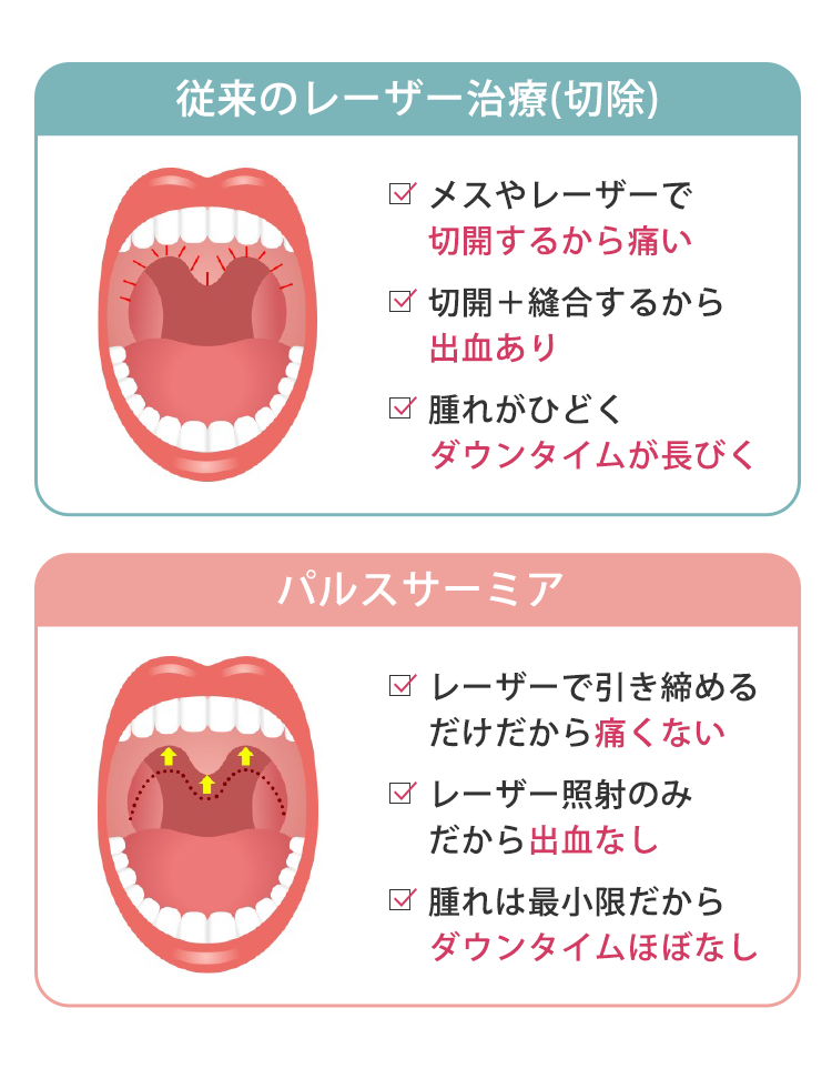 従来のレーザー治療(切除)　メスやレーザーで切開するから痛い　切開＋縫合するから出血あり　腫れがひどくダウンタイムが長びく　パルスサーミア　レーザーで引き締めるだけだから痛くない　レーザー照射のみから出血なし　腫れは最小限だからダウンタイムほぼなし
