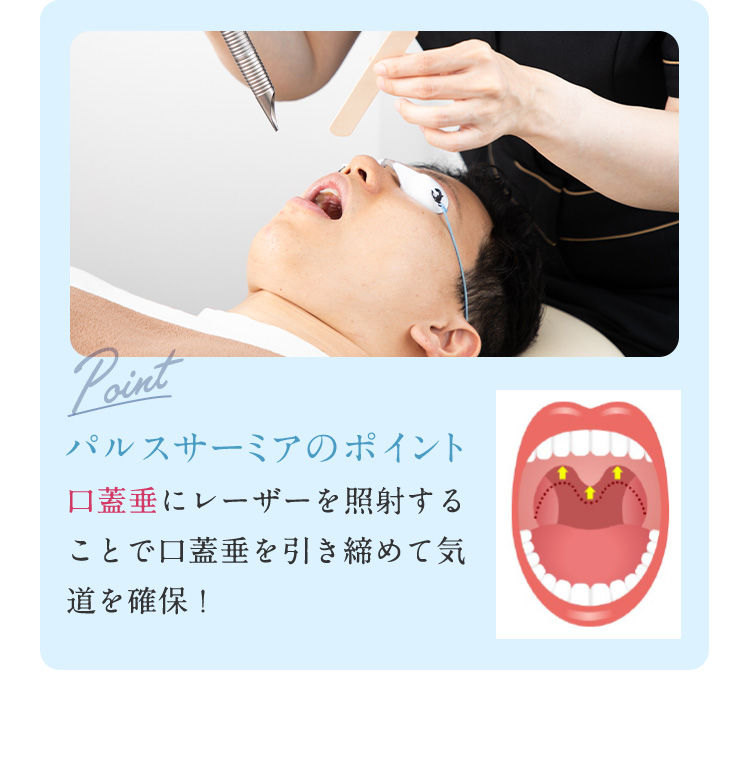 Point パルスサーミアのポイント 口蓋垂にレーザーを照射することで口蓋垂を引き締めて気道を確保！