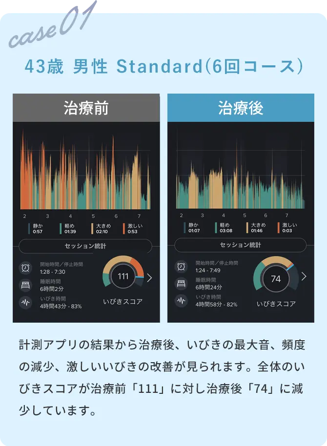 voice01 計測アプリの結果から治療後、いびきの最大音、頻度の減少、激しいいびきの改善が見られます。全体のいびきスコアが治療前「111」に対し治療後「74」に減少しています。43歳  男性 Standard(6回コース)