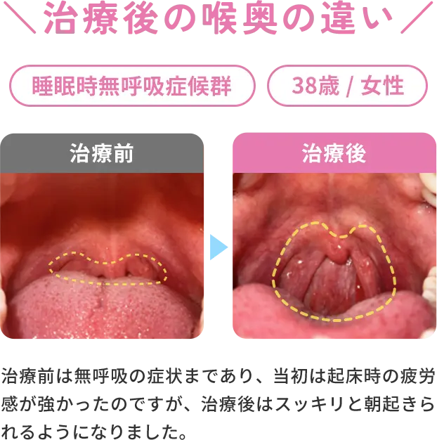 治療後の喉奥の違いの症例　睡眠時無呼吸症候群/38歳/女性