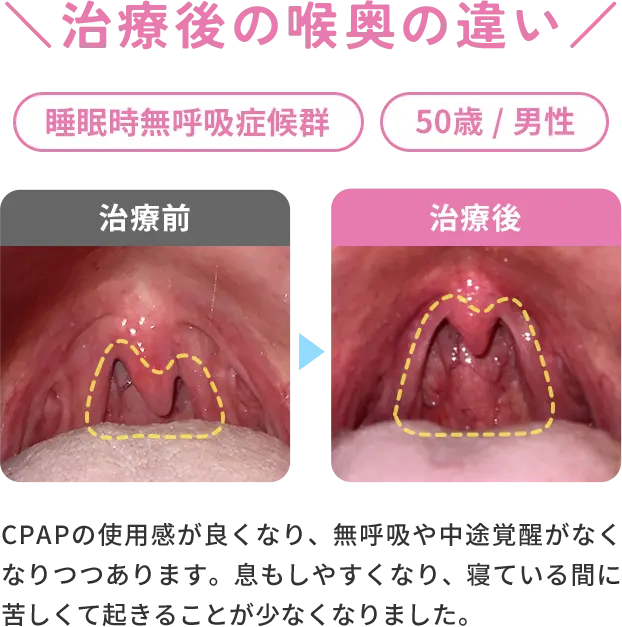 治療後の喉奥の違いの症例　睡眠時無呼吸症候群/50歳/男性