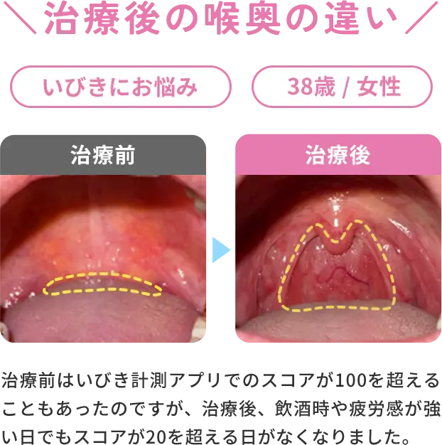 治療後の喉奥の違いの症例　いびきにお悩み/38歳/女性