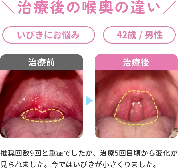 治療後の喉奥の違いの症例　いびきにお悩み/42歳/男性
