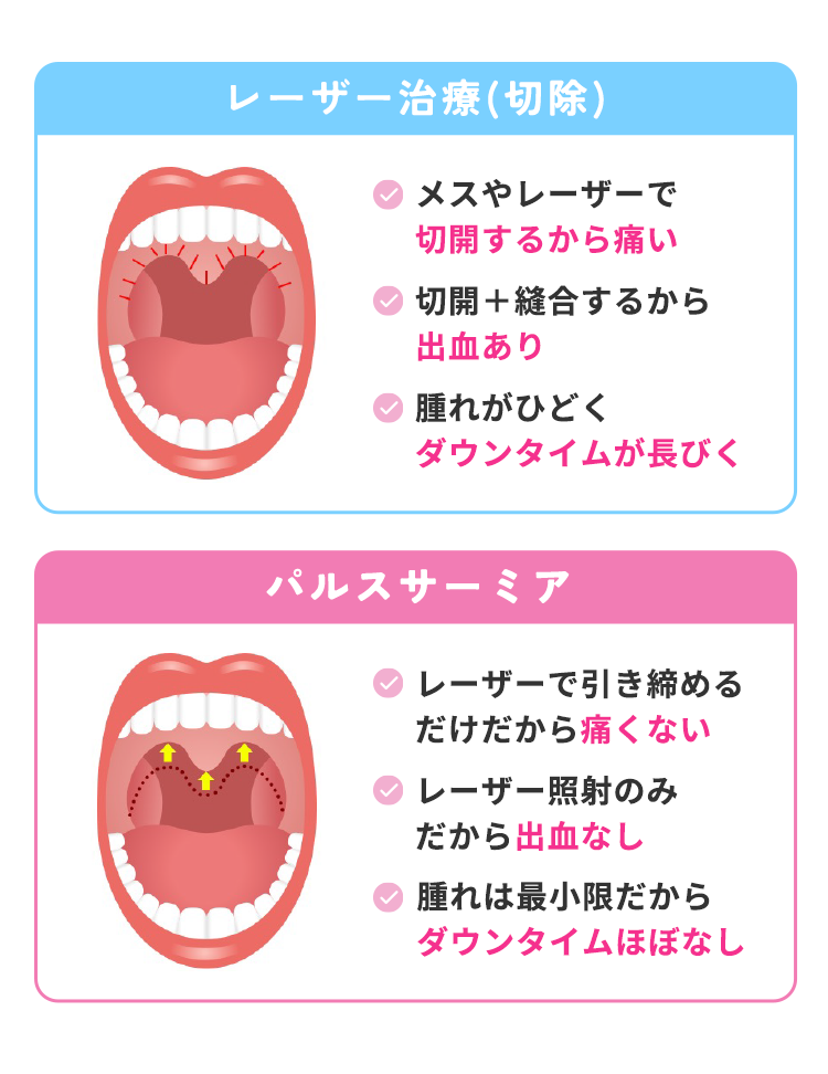 従来のレーザー治療(切除)　メスやレーザーで切開するから痛い　切開＋縫合するから出血あり　腫れがひどくダウンタイムが長びく　パルスサーミア　レーザーで引き締めるだけだから痛くない　レーザー照射のみから出血なし　腫れは最小限だからダウンタイムほぼなし
