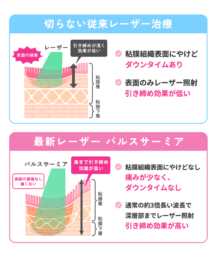 切らないレーザー治療　口蓋垂表面にやけどダウンタイムあり　表面のみレーザー照射引き締め効果が低い　パルスサーミア　口蓋垂表面にやけどなしダウンタイムなし　深層部までレーザー照射引き締め効果が高い