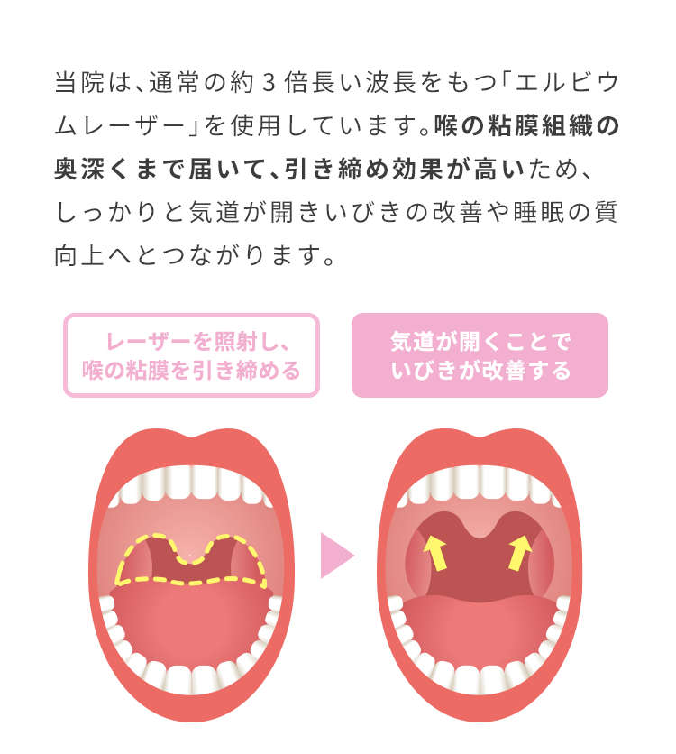 パルスサーミアは、口蓋垂(のど奥)にレーザーを照射することで引き締めて気道を確保します。パルスサ－ミアは、CPAPやマウスピースのような対症治療ではなくいびきの原因を根本から治療します。切らないから痛くない　ダウンタイムほぼなし　出血しない　治療時間約15分