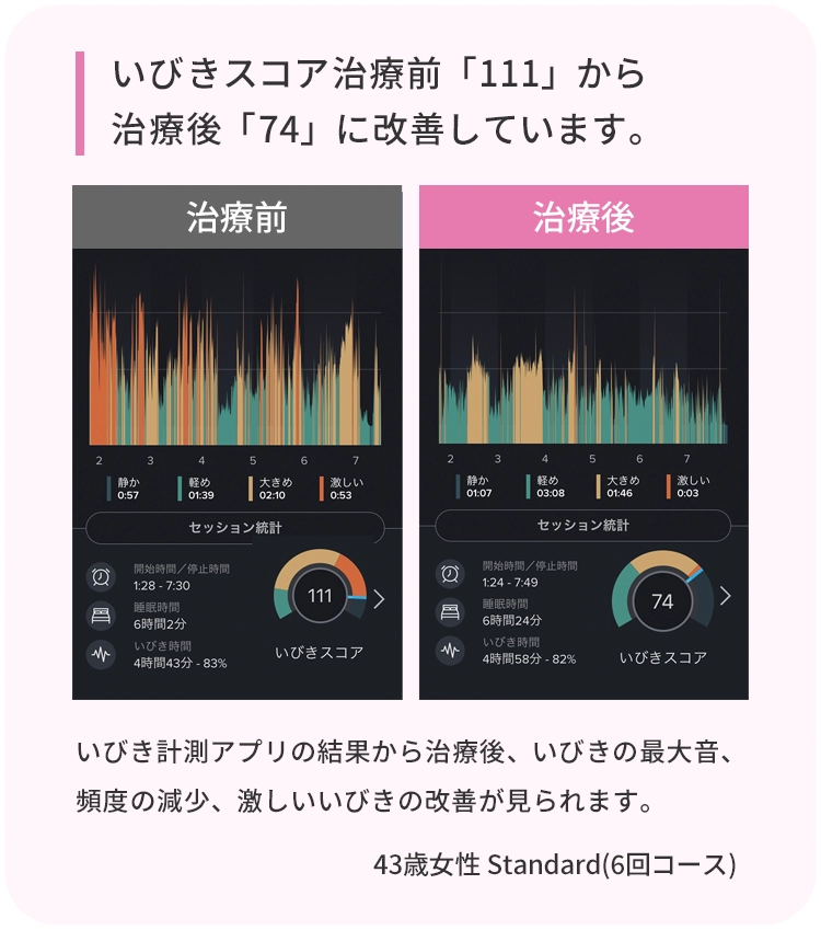 いびきスコア治療前「111」から治療後「74」に改善しています。 治療前 治療後 いびき計測アプリの結果から治療後、いびきの最大音、頻度の減少、激しいいびきの改善が見られます。　43歳男性 Standard(6回コース)