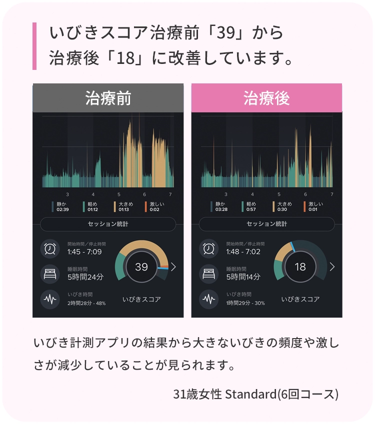いびきスコア治療前「39」から治療後「18」に改善しています。 治療前 治療後 いびき計測アプリの結果から大きないびきの頻度や激しさが減少していることが見られます。 31歳男性 Standard(6回コース)