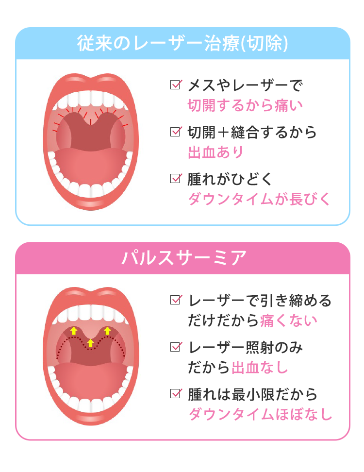 従来のレーザー治療(切除)　メスやレーザーで切開するから痛い　切開＋縫合するから出血あり　腫れがひどくダウンタイムが長びく　パルスサーミア　レーザーで引き締めるだけだから痛くない　レーザー照射のみから出血なし　腫れは最小限だからダウンタイムほぼなし