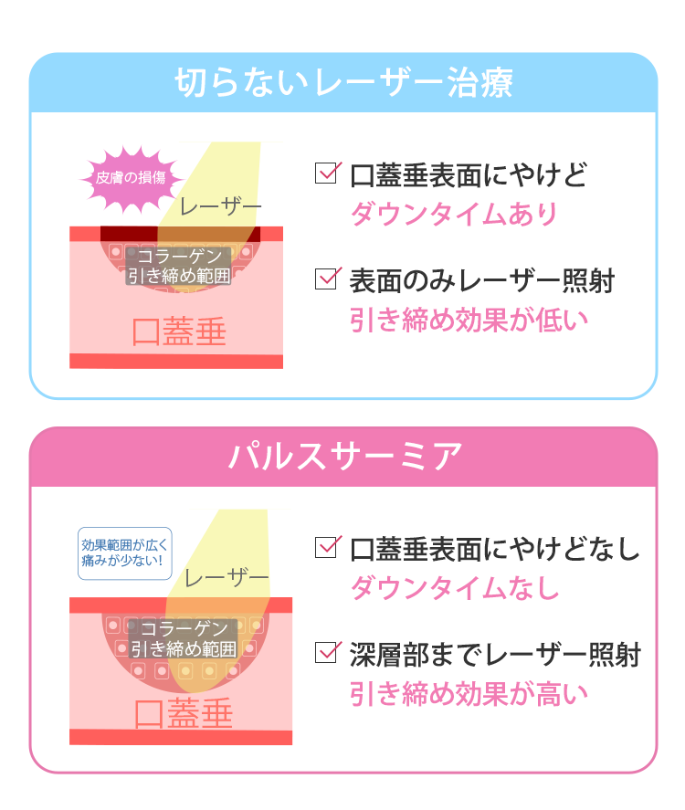 切らないレーザー治療　口蓋垂表面にやけどダウンタイムあり　表面のみレーザー照射引き締め効果が低い　パルスサーミア　口蓋垂表面にやけどなしダウンタイムなし　深層部までレーザー照射引き締め効果が高い