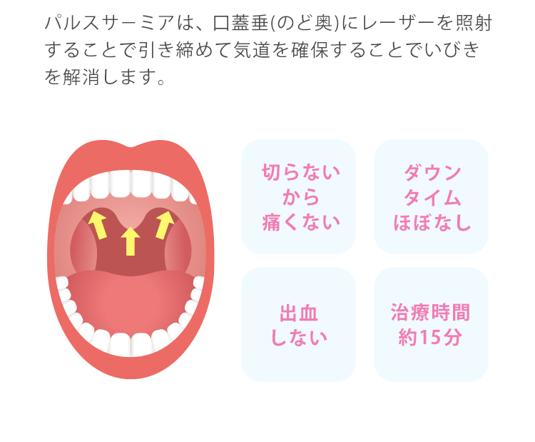 パルスサーミアは、口蓋垂(のど奥)にレーザーを照射することで引き締めて気道を確保します。パルスサ－ミアは、CPAPやマウスピースのような対症治療ではなくいびきの原因を根本から治療します。切らないから痛くない　ダウンタイムほぼなし　出血しない　治療時間約15分