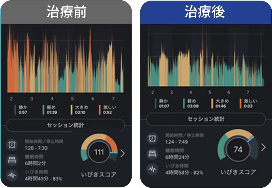 いびき計測アプリの測定結果