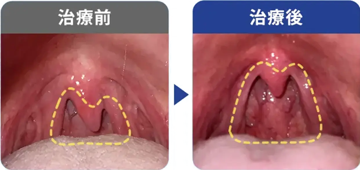 睡眠時無呼吸症候群50歳/男性の症例写真