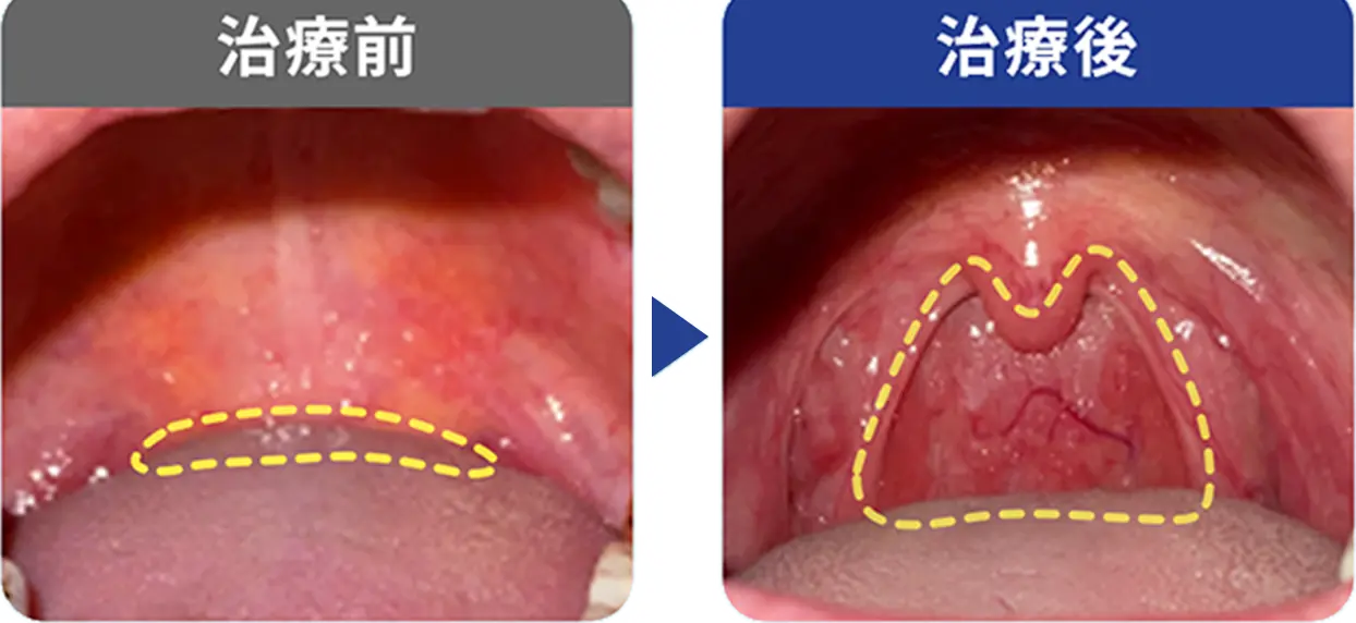 いびきにお悩みな38歳/女性の症例写真