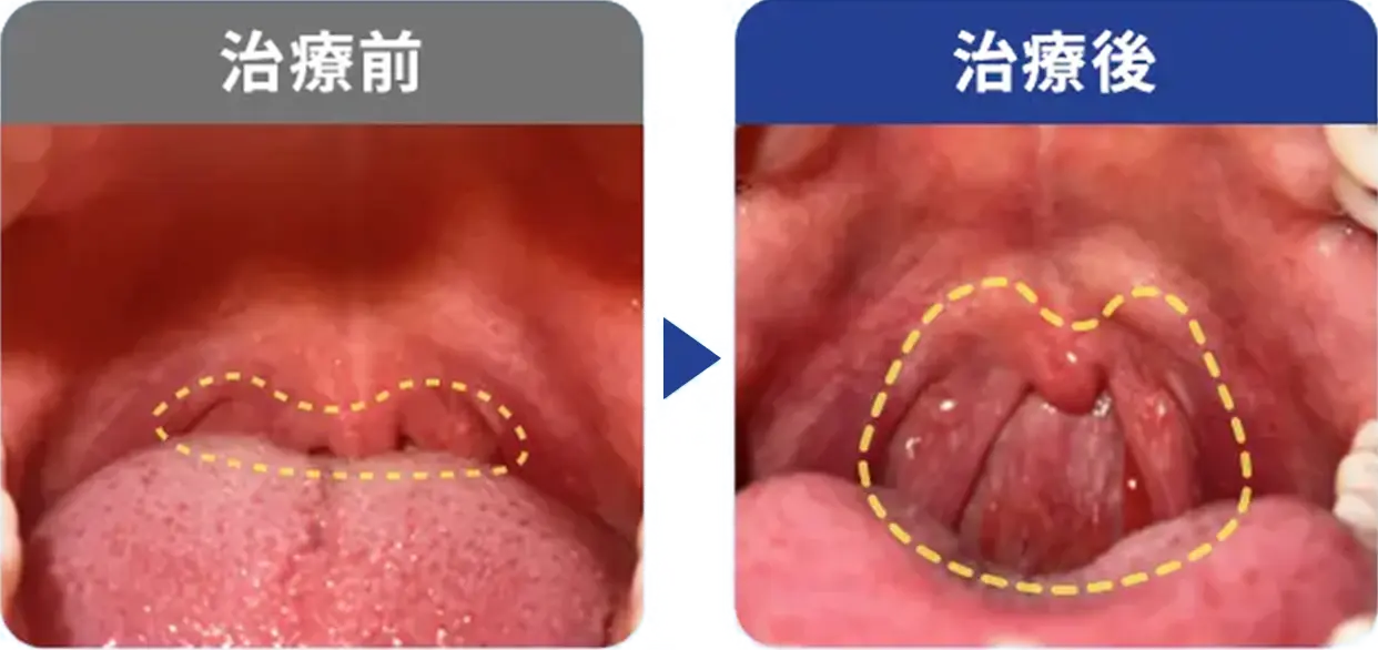 睡眠時無呼吸症候群38歳/女性の症例写真