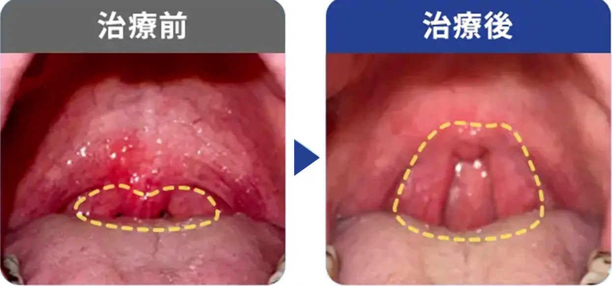 睡眠時無呼吸症候群42歳/男性の症例写真