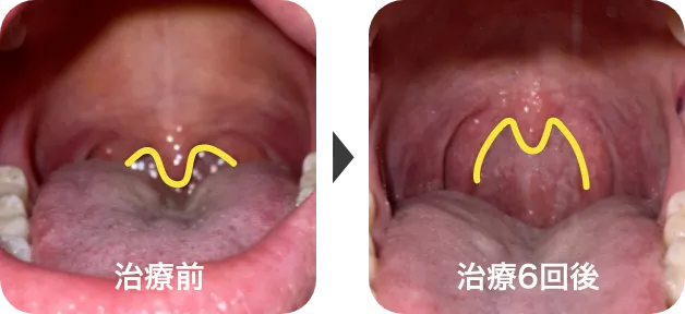 パルスサーミア治療6回の比較症例写真