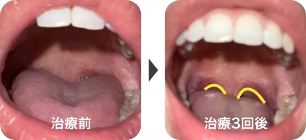 パルスサーミア治療3回の比較症例写真