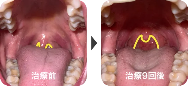 パルスサーミア治療9回の比較症例写真