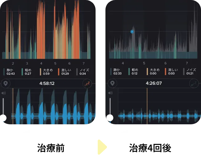 治療前後のいびき音の比較