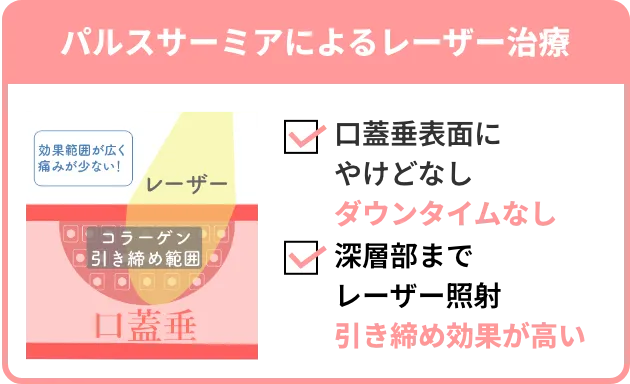 パルスサーミアによるレーザー治療は口蓋垂表面にやけどなし、ダウンタイムなし。深層部までレーザー照射をするため引き締め効果が高い。